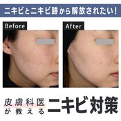 ニキビをつぶすのはやっぱりダメなの?ニキビ跡って治せるの?皮膚科医が教えるニキビ対策