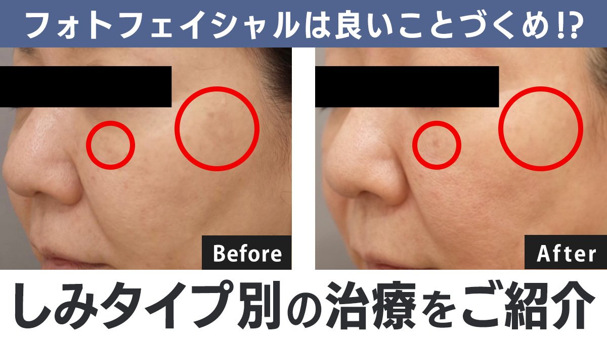 シミやそばかす、ニキビ跡や赤ら顔にお悩みの方の強い味方