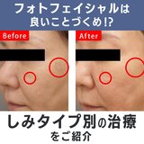 シミやそばかす、ニキビ跡や赤ら顔にお悩みの方の強い味方「フォトフェイシャル」は良いことづくめ⁉レーザーとの使い分けポイントも！【初心者さん向け美容医療】