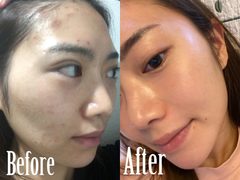 「“肌がすごくキレイだね”と、本当にめちゃくちゃ褒められるようになりました！！」美容に150万つぎ込んできた私が【本当に試してよかった！】と感じるサロン美容