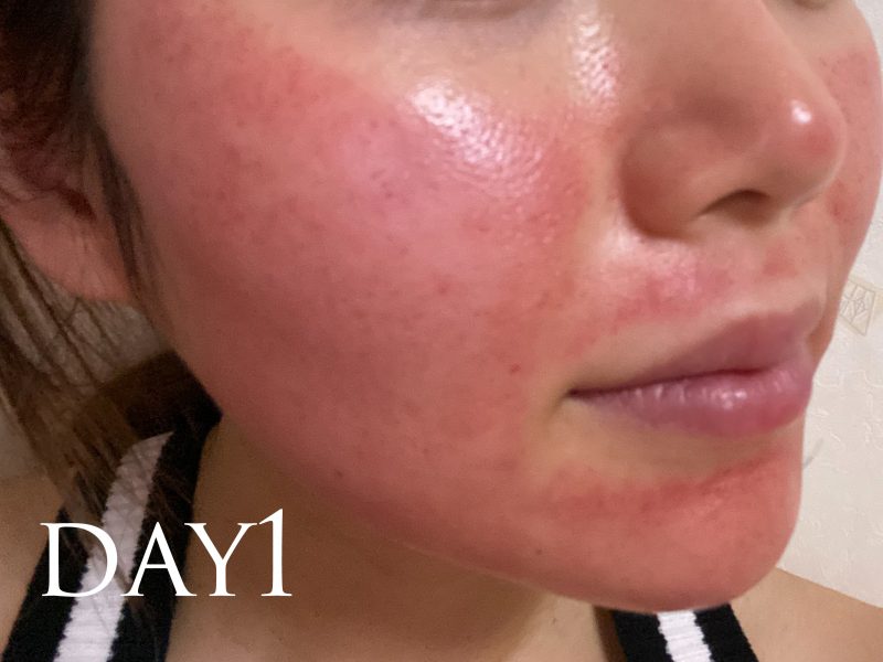 肌がすごくキレイだね と 本当にめちゃくちゃ褒められるようになりました 美容に150万つぎ込んできた私が 本当に試してよかった と感じるサロン美容 Arweb アールウェブ