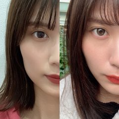 【私のやってよかった美容医療】ビフォーアフターから値段まで徹底レポ！