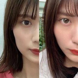 【私のやってよかった美容医療】ビフォーアフターから値段まで徹底レポ！