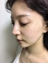 麻亜里さん　ニキビ肌→美肌へのビフォーアフター