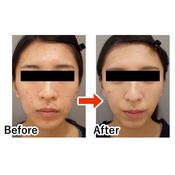 20代からボトックスを打っても大丈夫?打ち続けると不自然な表情になる?気になる疑問に医師がお答え♡【初心者さん向け美容医療】