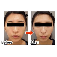 20代からボトックスを打っても大丈夫？打ち続けると不自然な表情になる？気になる疑問に医師がお答え♡【初心者さん向け美容医療】