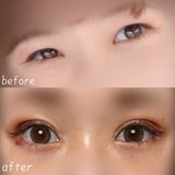 「二重整形ってぶっちゃけどうなの？」聞きたいけどなかなか聞けない術後レポを埋没切開全部やった人のリアルを大公開