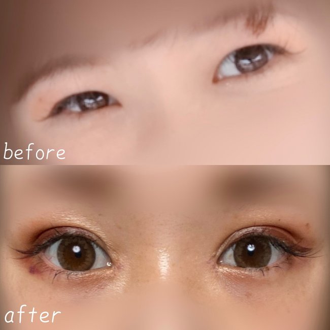 「二重整形ってぶっちゃけどうなの？」聞きたいけどなかなか聞けない術後レポを埋没切開全部やった人のリアルを大公開