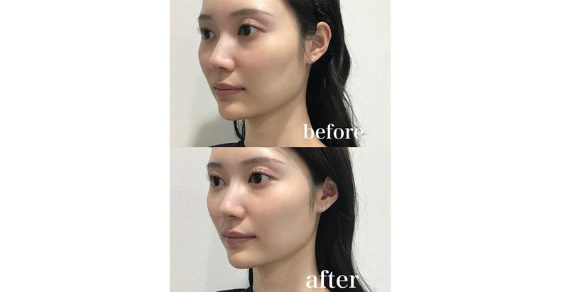 「細かいシミが気になり始めた…」初めての美容医療を現役美容ナースが指南！おすすめ美容医療3選