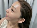 麻亜里さん ニキビ肌→美肌へのビフォーアフター