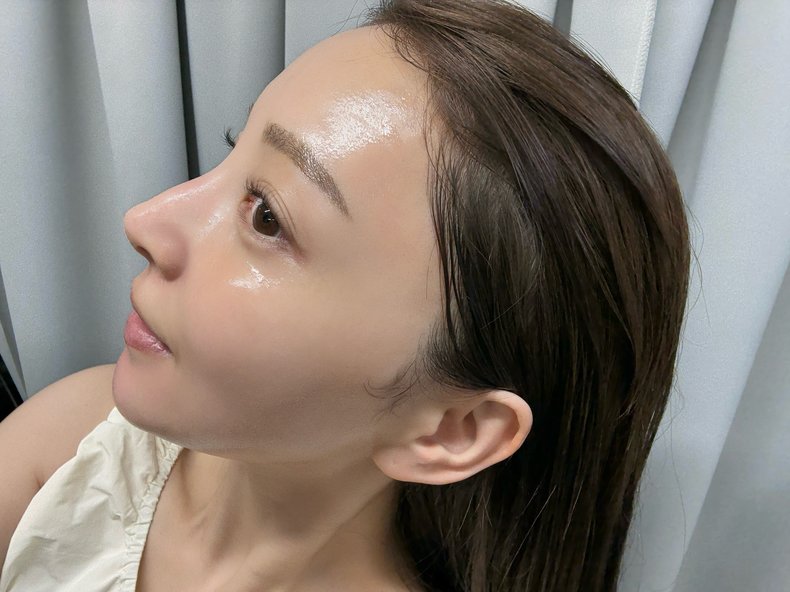 麻亜里さん ニキビ肌→美肌へのビフォーアフター
