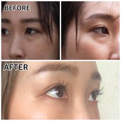 クマ取りやクマ取り再生注射って実際どう？　ダウンタイムや施術内容、効果を徹底比較！実際にやってみた人の体験レポートも