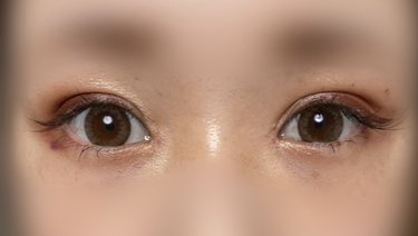 二重整形ってぶっちゃけどうなの？」聞きたいけどなかなか聞け
