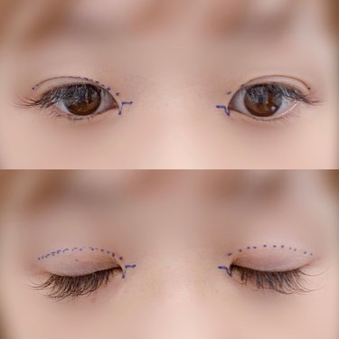 二重整形ってぶっちゃけどうなの 聞きたいけどなかなか聞けない術後レポを埋没切開全部やった人のリアルを大公開 Arweb アールウェブ 2ページ目 大好きな人にモテるための髪型 メイク ファッション情報満載