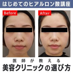 鼻に打つヒアルロン酸って安全なの？どうやって病院を選べばいい？医師が教えるはじめてのヒアルロン酸講座！【初心者さん向け美容医療】