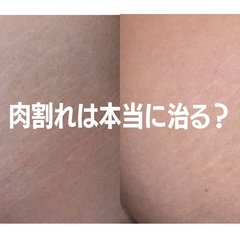 肉割れ、妊娠線の治し方を皮膚科医に徹底取材！　レーザーの効果は？クリームに意味はある？　クリニック選びのポイントも