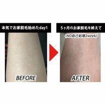 「医療脱毛でも完全に毛をなくしたいなら…」VIOは何回でツルツルになる?お家脱毛器って効果あるの?【アラサー女子3人のリアル脱毛&ボディケアトーク】