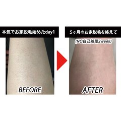 「医療脱毛でも完全に毛をなくしたいなら…」VIOは何回でツルツルになる？お家脱毛器って効果あるの？【アラサー女子3人のリアル脱毛＆ボディケアトーク】