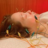 美容鍼の効果って？痛みはあるの？ライターが実際にやってみたbefore/afterをご紹介