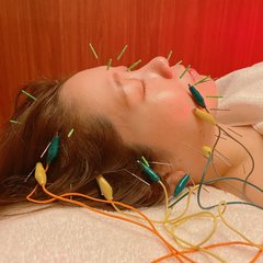 美容鍼の効果って？痛みはあるの？ライターが実際にやってみたbefore/afterをご紹介