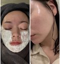 施術1ヶ月後には肌の光沢感アップ♡(左)施術前/(右)施術後
