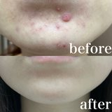 【え、そんなことで？】皮膚科医に教わった方法を試したらニキビ肌からノーファンデ肌になれた件