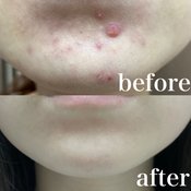 【え、そんなことで？】皮膚科医に教わった方法を試したらニキビ肌からノーファンデ肌になれた件