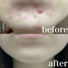 【え、そんなことで？】皮膚科医に教わった方法を試したらニキビ肌からノーファンデ肌になれた件