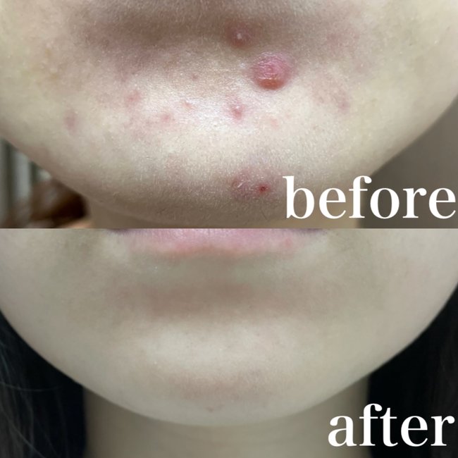 【え、そんなことで？】皮膚科医に教わった方法を試したらニキビ肌からノーファンデ肌になれた件