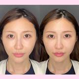 ハイフってやめたほうがいいの？効果はどのくらい？メリット、デメリットを美容外科に取材【オススメのハイフ医療4選】