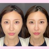 ハイフってやめたほうがいいの?効果はどのくらい?メリット、デメリットを美容外科に取材【オススメのハイフ医療4選】