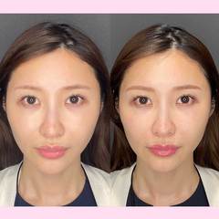 ハイフってやめたほうがいいの？効果はどのくらい？メリット、デメリットを美容外科に取材【オススメのハイフ医療4選】