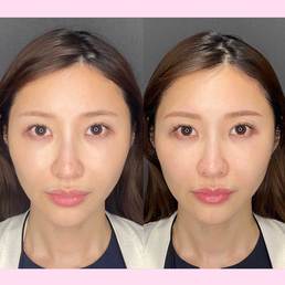 ハイフってやめたほうがいいの？効果はどのくらい？メリット、デメリットを美容外科に取材【オススメのハイフ医療4選】