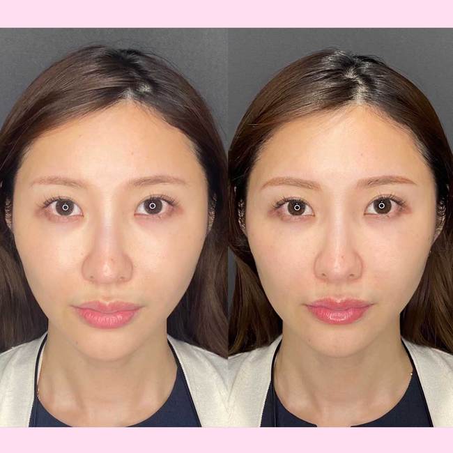 ハイフってやめたほうがいいの？効果はどのくらい？メリット、デメリットを美容外科に取材【オススメのハイフ医療4選】